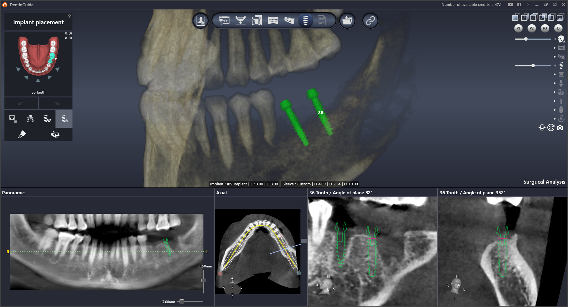 Интерфейс DentiqGuide 3