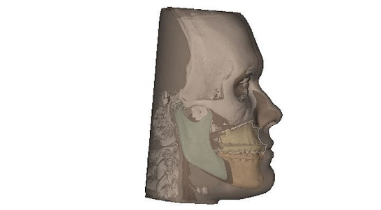 IPS Case Designer