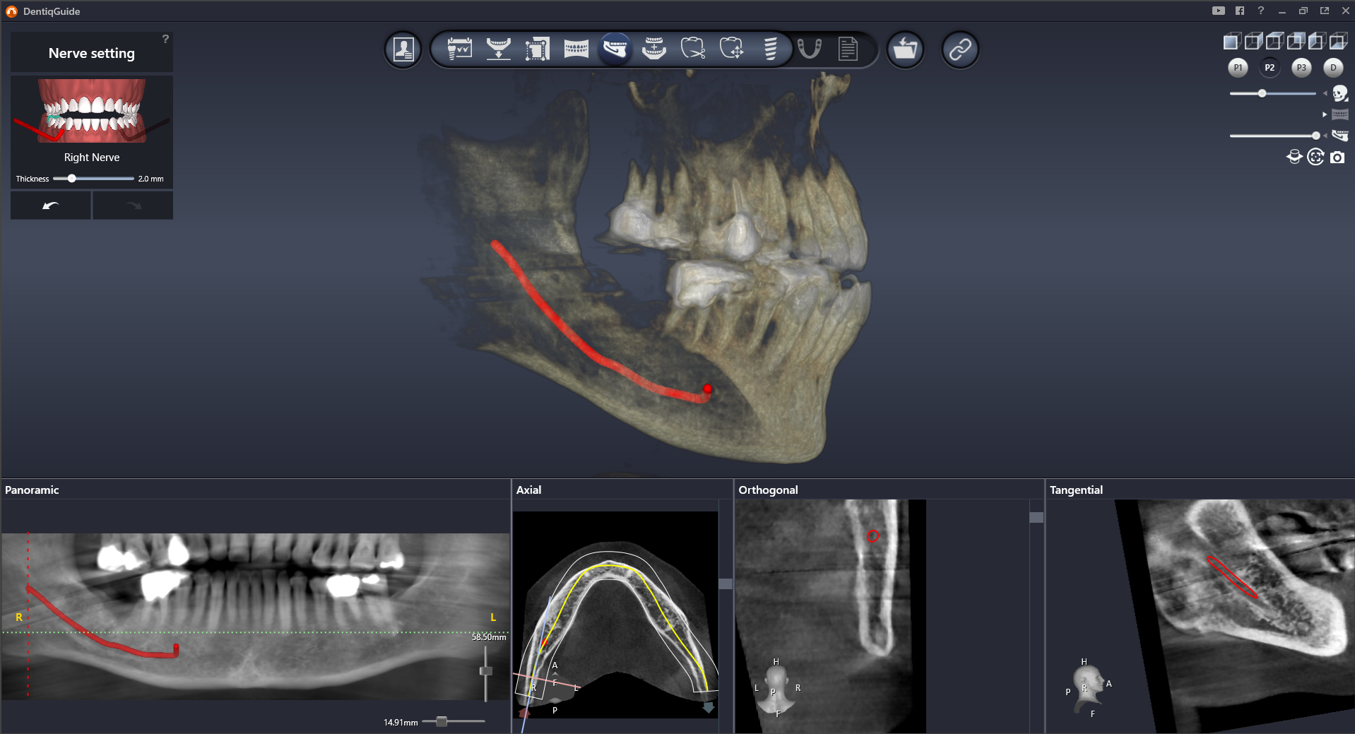 Обнаружение нервных каналов