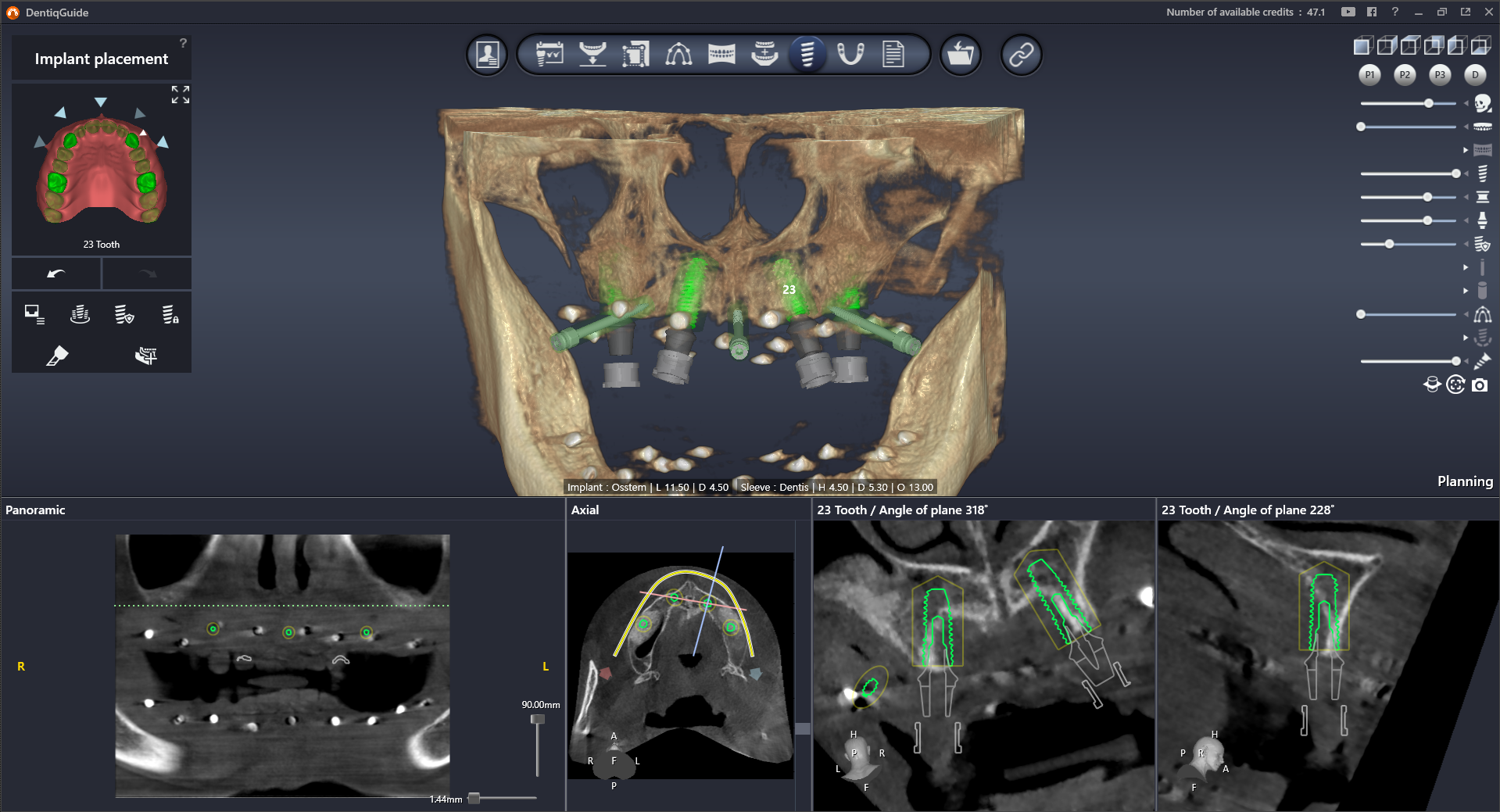 Интерфейс DentiqGuide 1