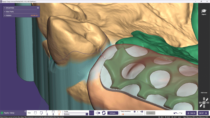 exocad_PartialCAD_Elefsina_Design_of_clasps_with_a_single_click_feature_03.gif