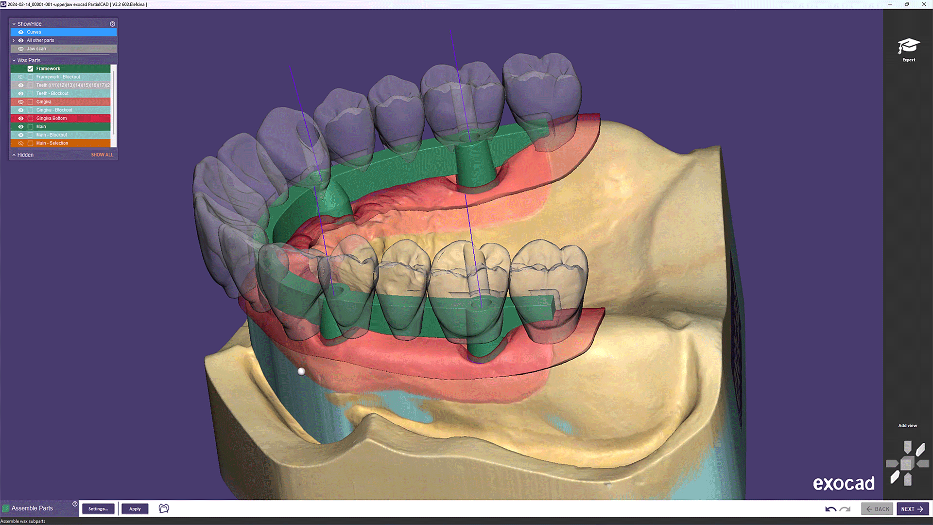 exocad_PartialCAD_Elefsina_Screw_retained_hybrid_denture_with_QuickSnap_feature_02.gif
